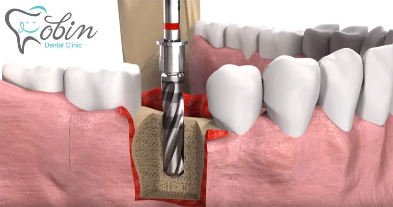 پاسخ به مهمترین سوالات در مورد ایمپلنت دندان!